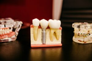 dental implant model with teeth